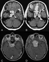 MRI scan